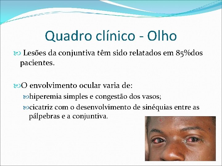 Quadro clínico - Olho Lesões da conjuntiva têm sido relatados em 85%dos pacientes. O