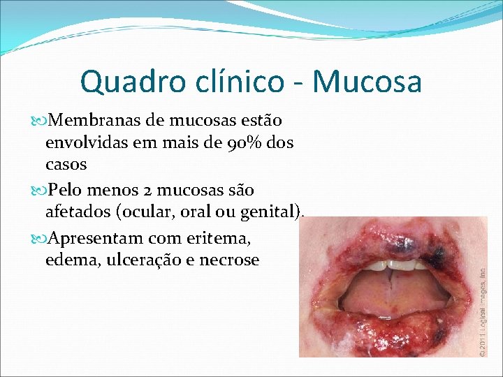 Quadro clínico - Mucosa Membranas de mucosas estão envolvidas em mais de 90% dos