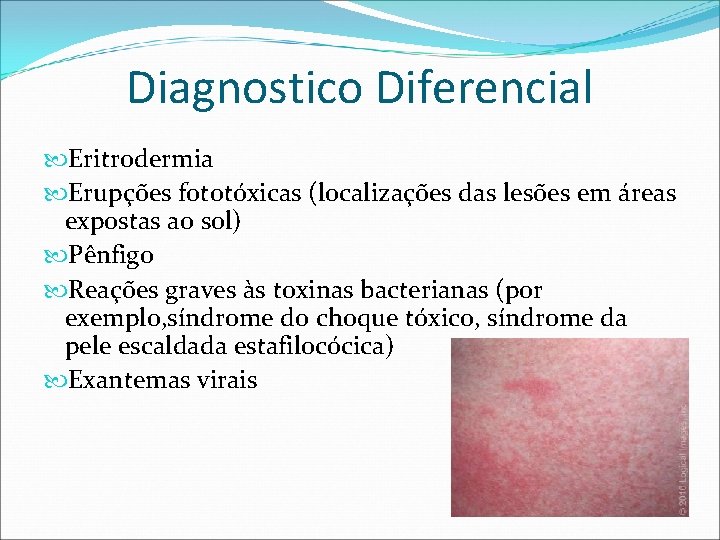 Diagnostico Diferencial Eritrodermia Erupções fototóxicas (localizações das lesões em áreas expostas ao sol) Pênfigo