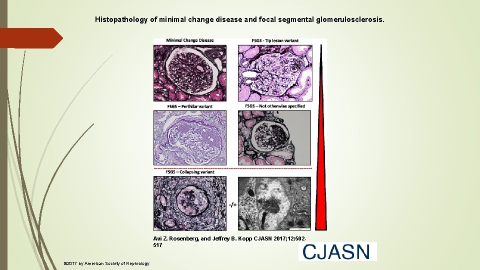 Histopathology of minimal change disease and focal segmental glomerulosclerosis. Avi Z. Rosenberg, and Jeffrey Histopathology of minimal change disease and focal segmental glomerulosclerosis. Avi Z. Rosenberg, and Jeffrey