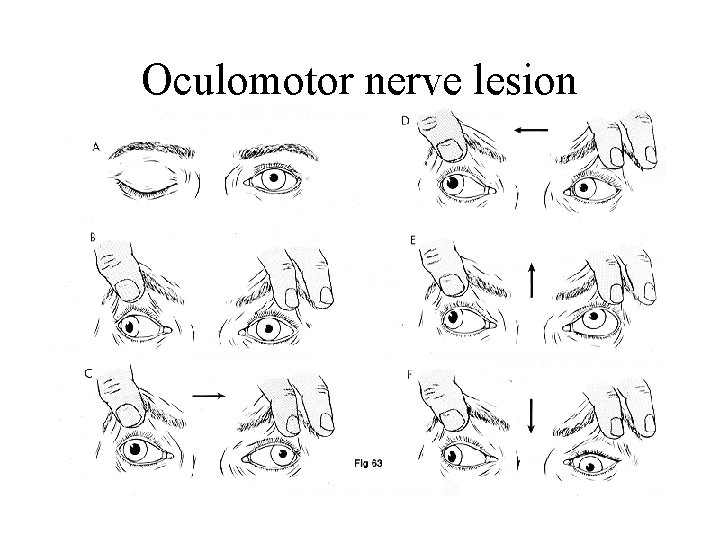 Oculomotor nerve lesion 