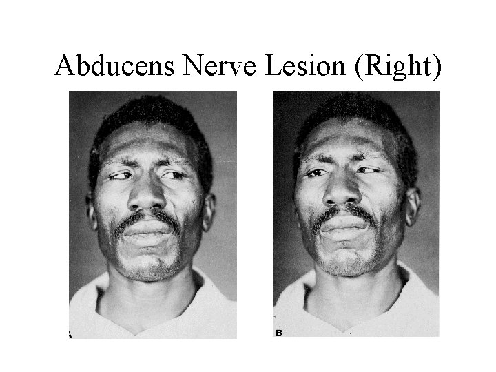 Abducens Nerve Lesion (Right) 