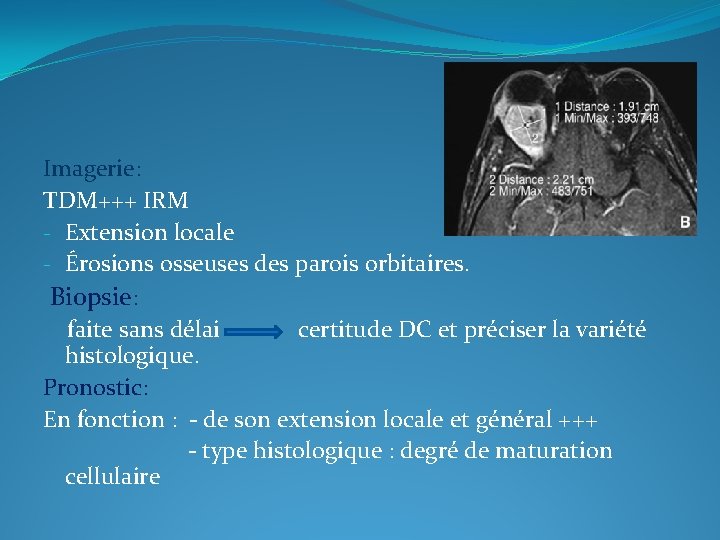 Imagerie: TDM+++ IRM - Extension locale - Érosions osseuses des parois orbitaires. Biopsie: faite