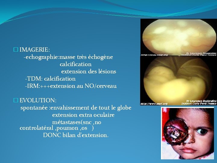 � IMAGERIE: -echographie: masse très échogène calcification extension des lésions -TDM: calcification -IRM: +++extension