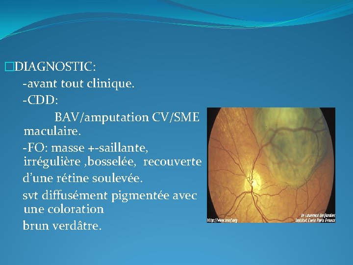 �DIAGNOSTIC: -avant tout clinique. -CDD: BAV/amputation CV/SME maculaire. -FO: masse +-saillante, irrégulière , bosselée,