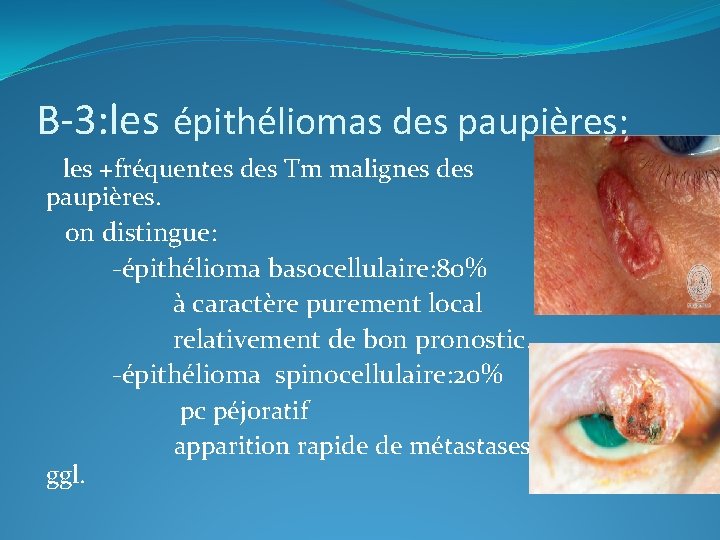 B-3: les épithéliomas des paupières: les +fréquentes des Tm malignes des paupières. on distingue: