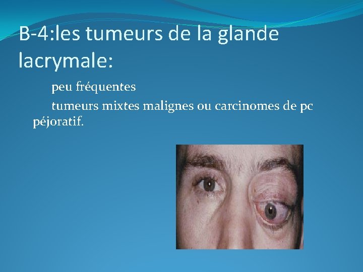 B-4: les tumeurs de la glande lacrymale: peu fréquentes tumeurs mixtes malignes ou carcinomes