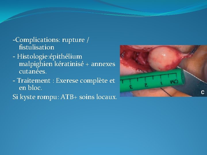 -Complications: rupture / fistulisation - Histologie: épithélium malpighien kératinisé + annexes cutanées. - Traitement