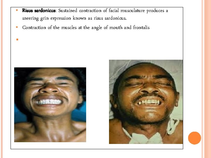  Risus sardonicus: Sustained contraction of facial musculature produces a sneering grin expression known