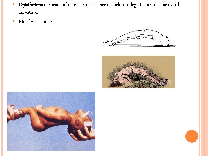  Opisthotonus: Spasm of extensor of the neck, back and legs to form a