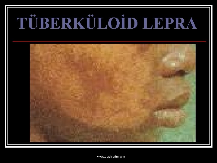 TÜBERKÜLOİD LEPRA www. slaytyerim. com 