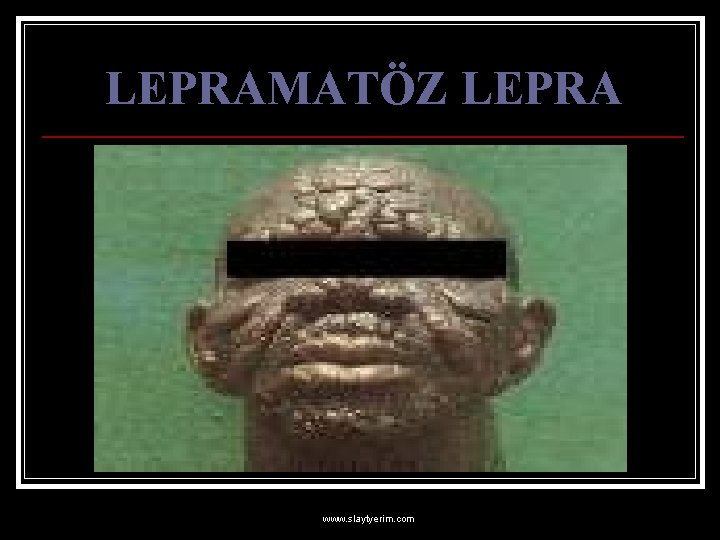 LEPRAMATÖZ LEPRA www. slaytyerim. com 