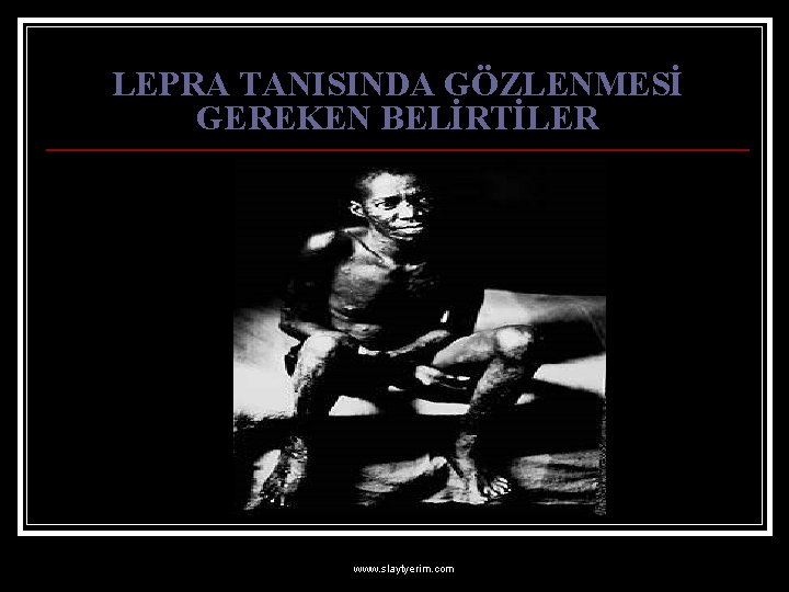 LEPRA TANISINDA GÖZLENMESİ GEREKEN BELİRTİLER www. slaytyerim. com 