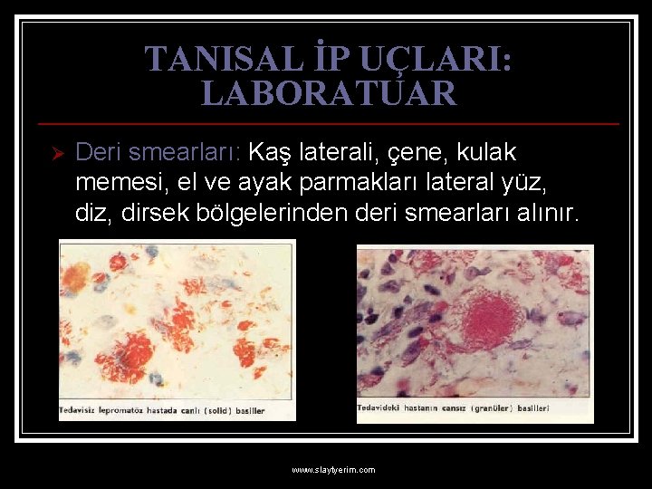 TANISAL İP UÇLARI: LABORATUAR Ø Deri smearları: Kaş laterali, çene, kulak memesi, el ve