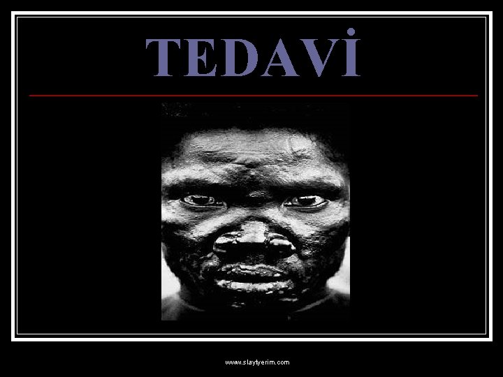 TEDAVİ www. slaytyerim. com 