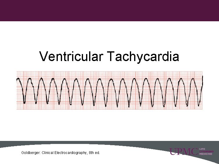Ventricular Tachycardia 24 Goldberger: Clinical Electrocardiography, 8 th ed. 