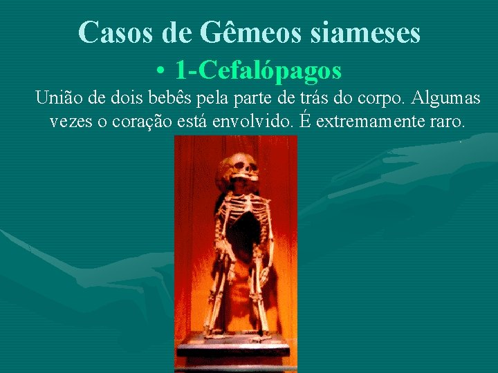 Casos de Gêmeos siameses • 1 -Cefalópagos União de dois bebês pela parte de