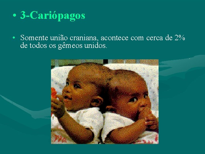  • 3 -Cariópagos • Somente união craniana, acontece com cerca de 2% de