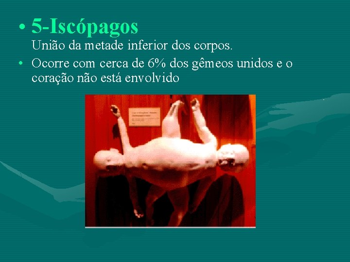  • 5 -Iscópagos União da metade inferior dos corpos. • Ocorre com cerca