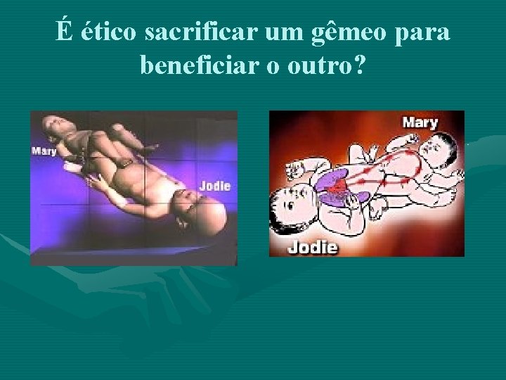 É ético sacrificar um gêmeo para beneficiar o outro? 