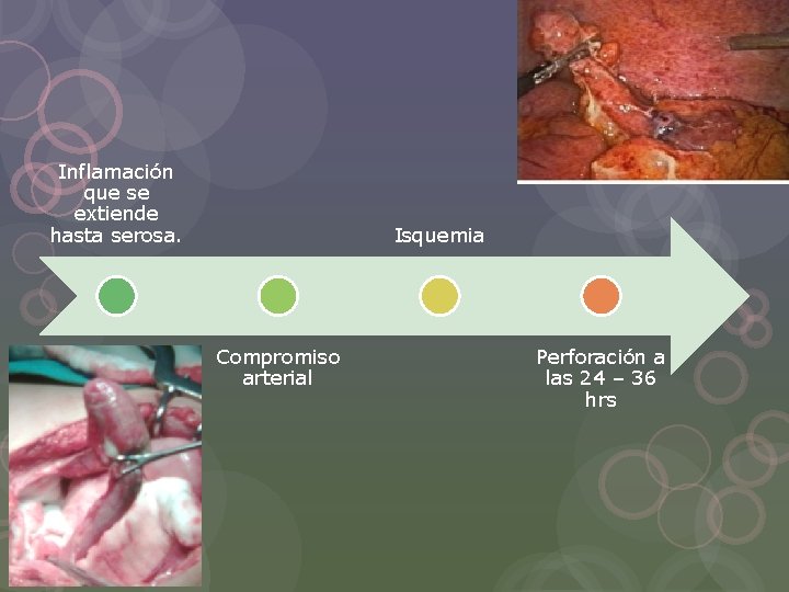 Inflamación que se extiende hasta serosa. Isquemia Compromiso arterial Perforación a las 24 –