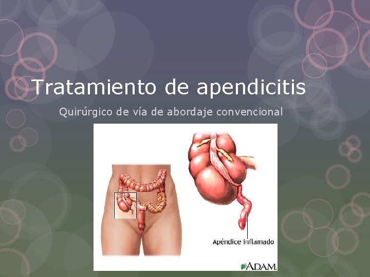 Tratamiento de apendicitis Quirúrgico de vía de abordaje convencional 