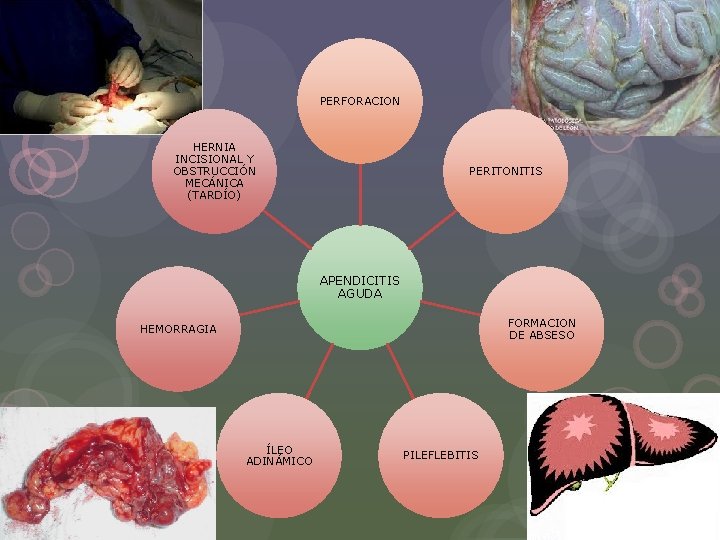 PERFORACION HERNIA INCISIONAL Y OBSTRUCCIÓN MECÁNICA (TARDÍO) PERITONITIS APENDICITIS AGUDA FORMACION DE ABSESO HEMORRAGIA