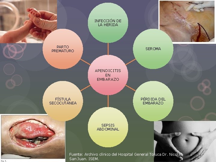 INFECCIÓN DE LA HERIDA PARTO PREMATURO SEROMA APENDICITIS EN EMBARAZO FÍSTULA SECOCUTÁNEA PÉRDIDA DEL