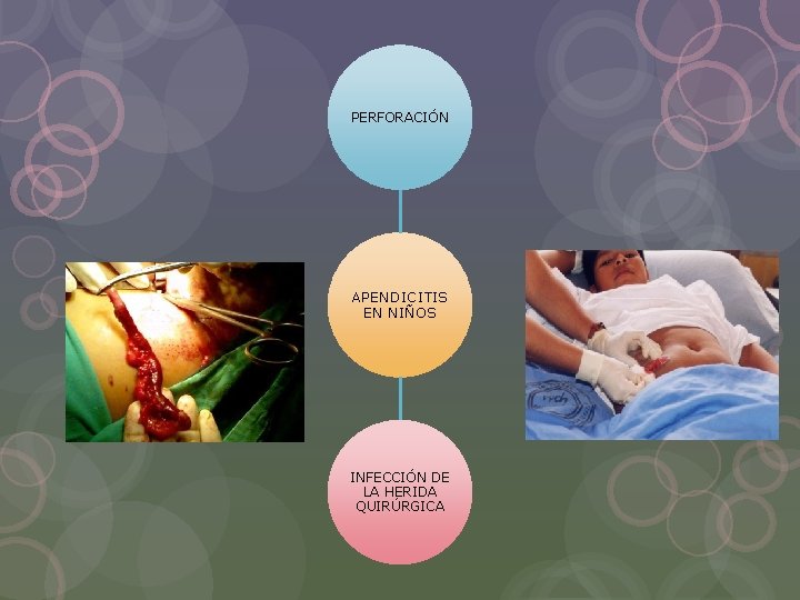 PERFORACIÓN APENDICITIS EN NIÑOS INFECCIÓN DE LA HERIDA QUIRÚRGICA 