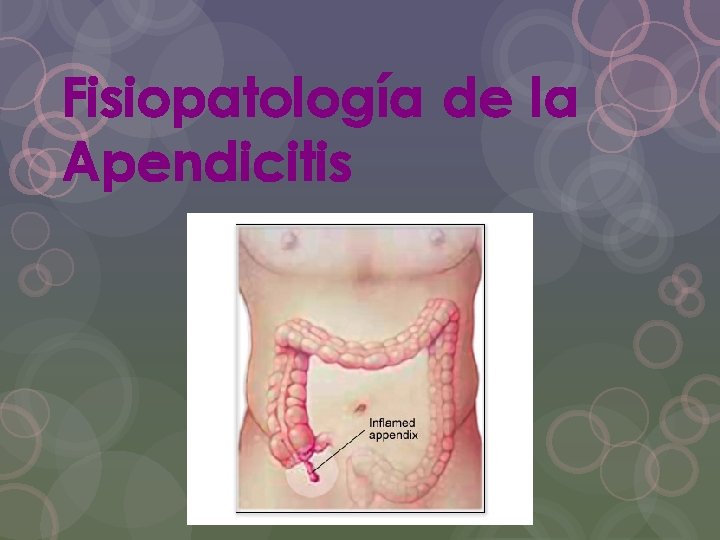 Fisiopatología de la Apendicitis 