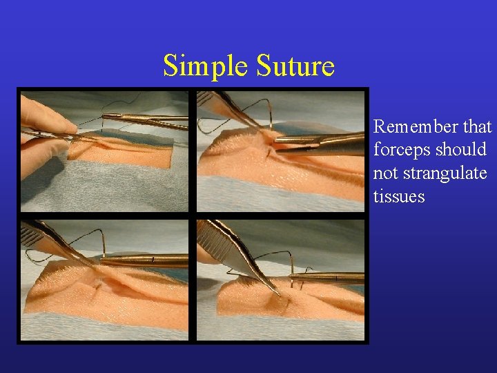 Simple Suture Remember that forceps should not strangulate tissues Simple Suture Remember that forceps should not strangulate tissues