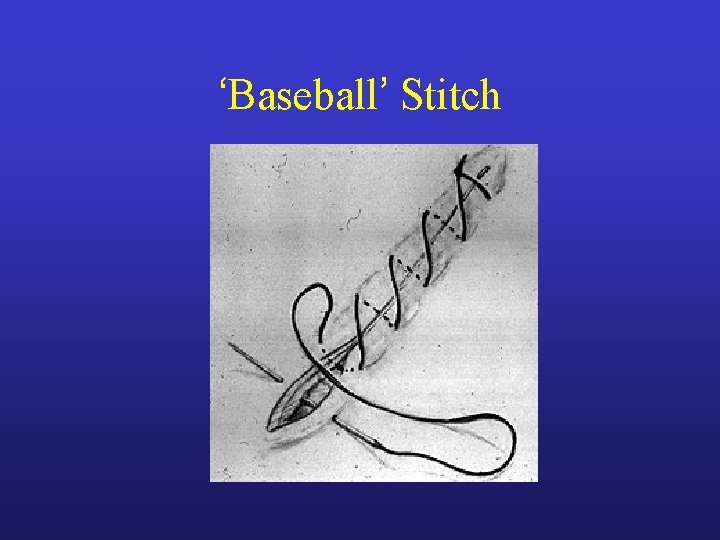 ‘Baseball’ Stitch ‘Baseball’ Stitch