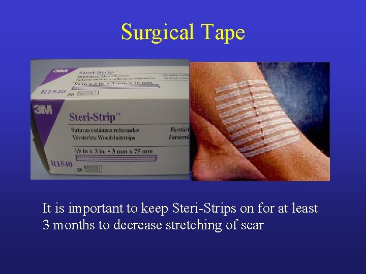 Surgical Tape It is important to keep Steri-Strips on for at least 3 months Surgical Tape It is important to keep Steri-Strips on for at least 3 months