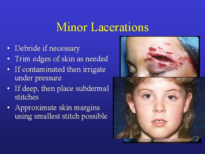 Minor Lacerations • Debride if necessary • Trim edges of skin as needed • Minor Lacerations • Debride if necessary • Trim edges of skin as needed •