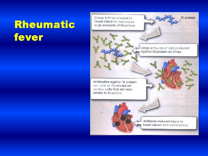 Rheumatic fever 