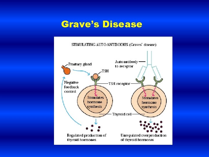 Grave’s Disease 