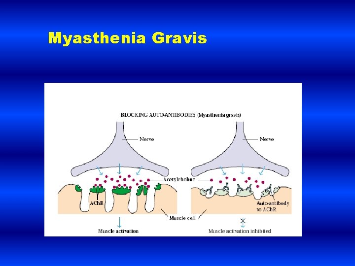 Myasthenia Gravis 