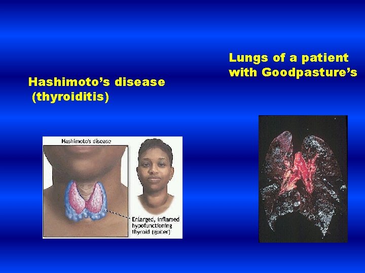 Hashimoto’s disease (thyroiditis) Lungs of a patient with Goodpasture’s 