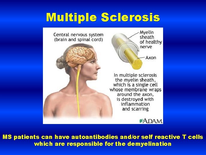 Multiple Sclerosis MS patients can have autoantibodies and/or self reactive T cells which are