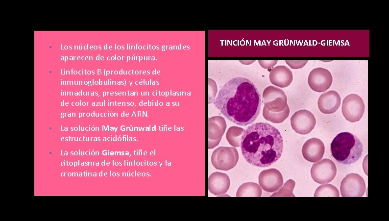 § Los núcleos de los linfocitos grandes aparecen de color púrpura. § Linfocitos B