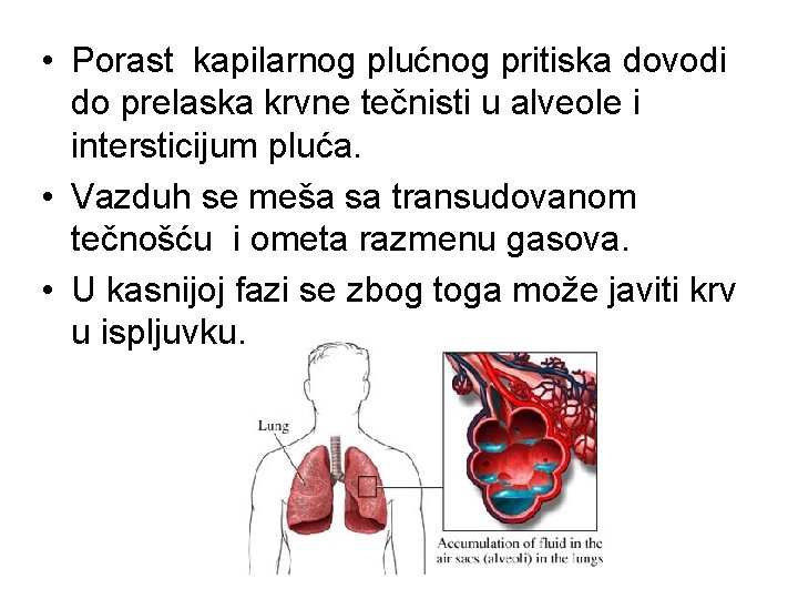  • Porast kapilarnog plućnog pritiska dovodi do prelaska krvne tečnisti u alveole i
