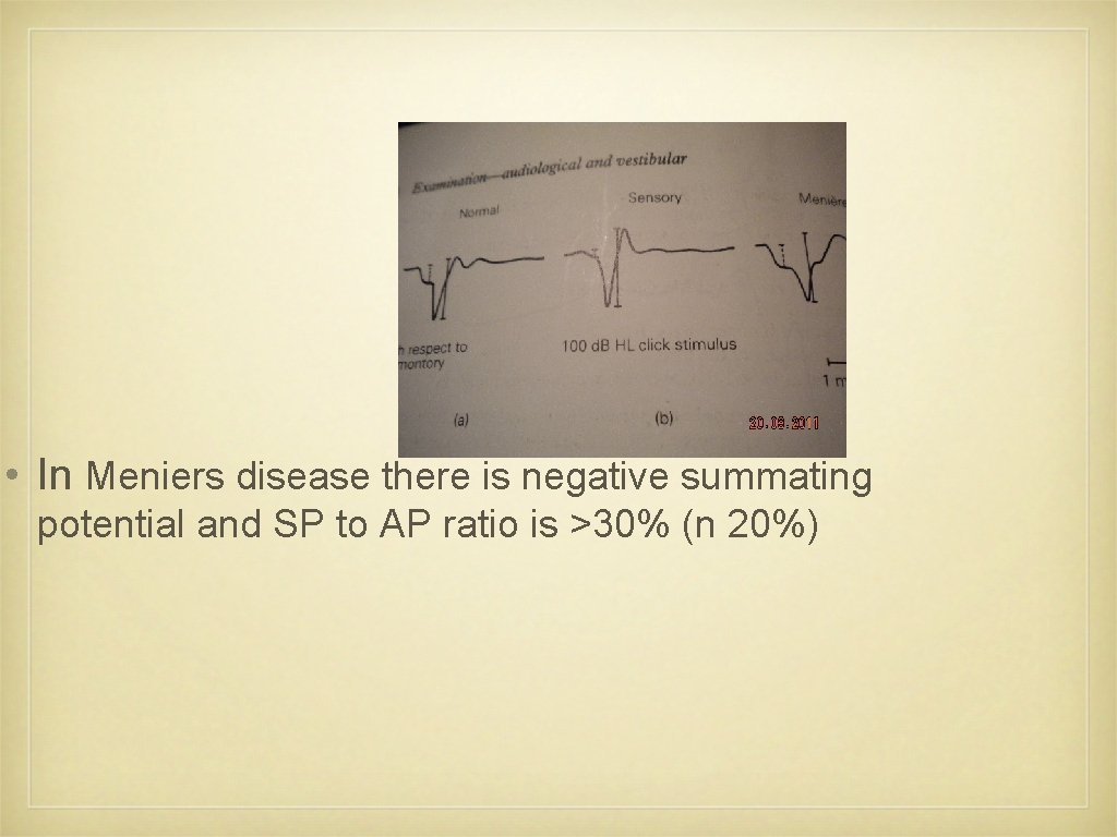  • In Meniers disease there is negative summating potential and SP to AP