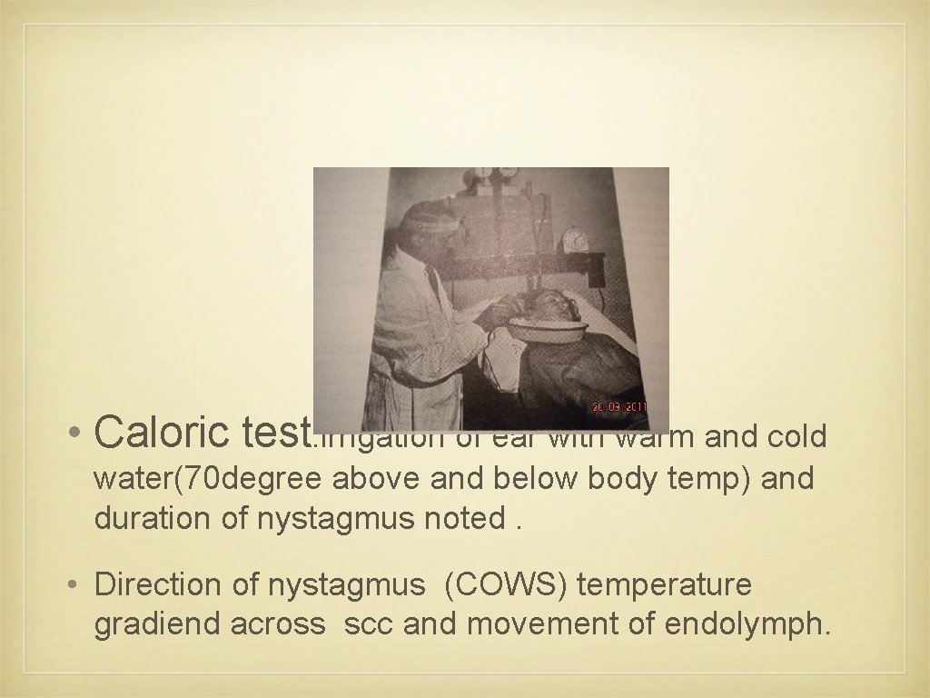  • Caloric test: irrigation of ear with warm and cold water(70 degree above