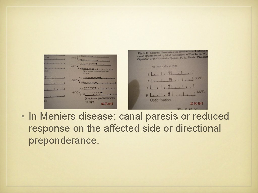  • In Meniers disease: canal paresis or reduced response on the affected side