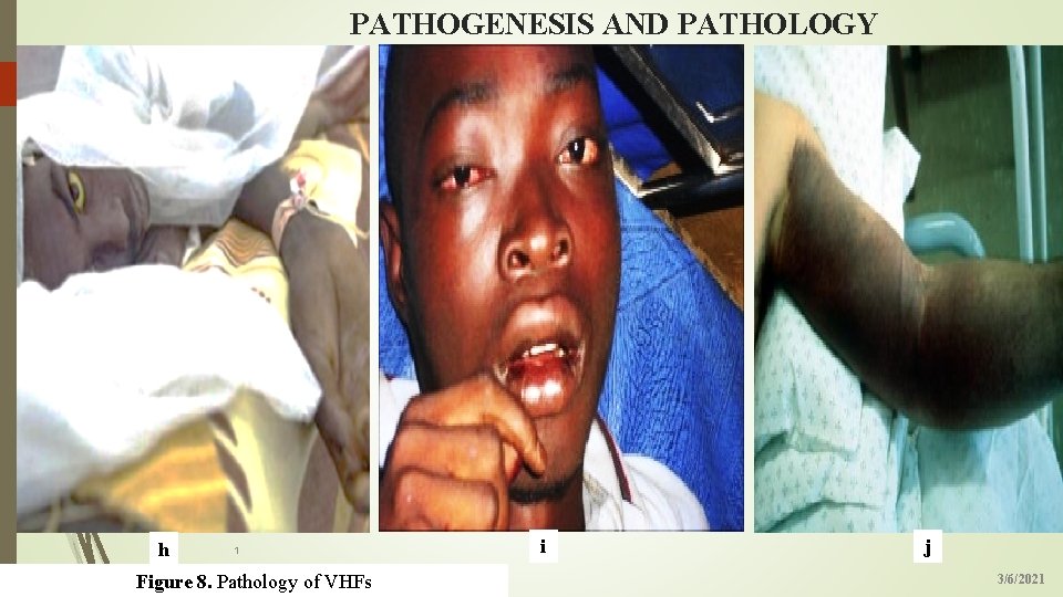 PATHOGENESIS AND PATHOLOGY 19 h 1 Figure 8. Pathology of VHFs i j 3/6/2021