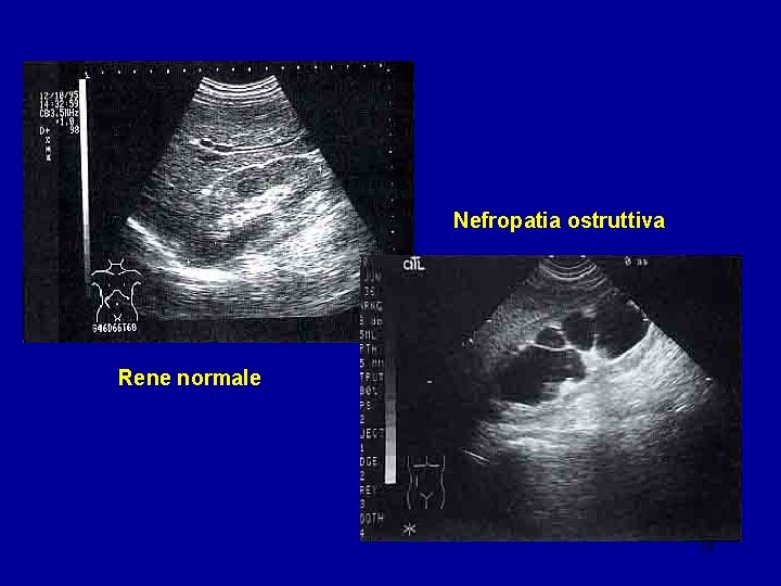 Nefropatia ostruttiva Rene normale 16 