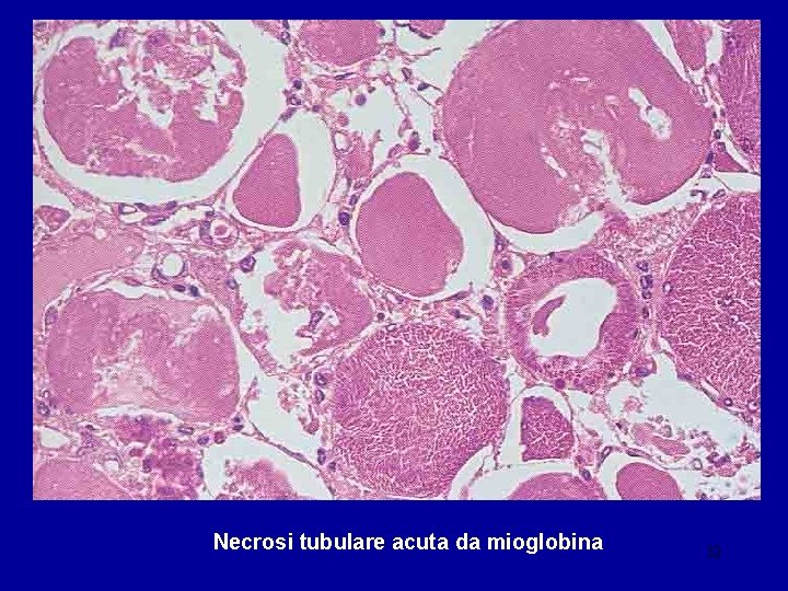 Necrosi tubulare acuta da mioglobina 32 