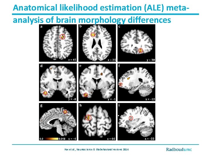 Anatomical likelihood estimation (ALE) metaanalysis of brain morphology differences Fox et al. , Neuroscience