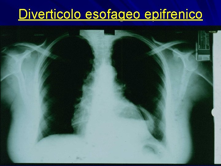 Diverticolo esofageo epifrenico 