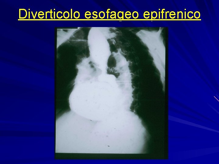 Diverticolo esofageo epifrenico 